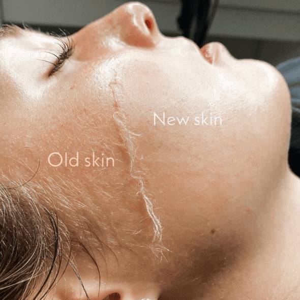 Dermaplane Luxe Facial Package at Serenity Skin Studio in Wichita, KS